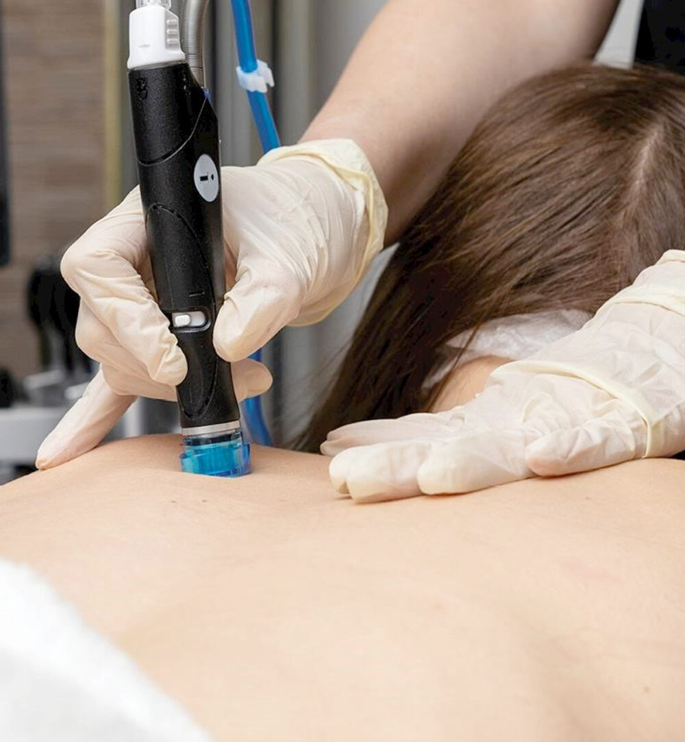 Тяло | Hydrafacial Syndeo