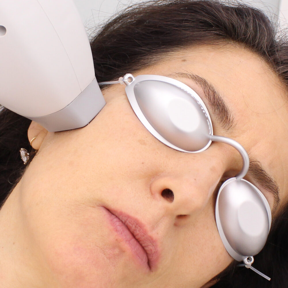 Бакенбарди - Prime Lase HR / лазерна епилация жени / Русе Prime Lase HR