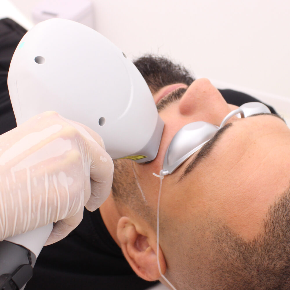 Бузи - Prime Lase HR / лазерна епилация мъже / Русе Prime Lase HR