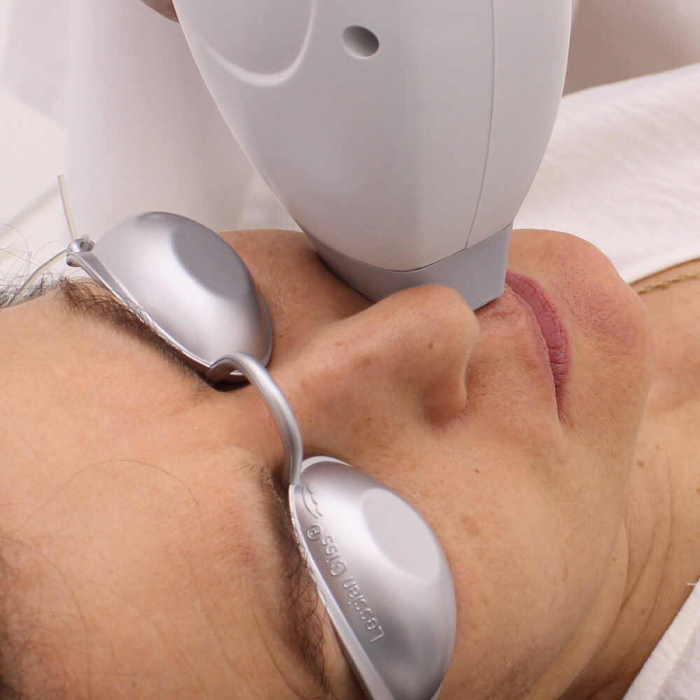 Горна устна - Prime Lase HR / лазерна епилация жени / Русе Prime Lase HR