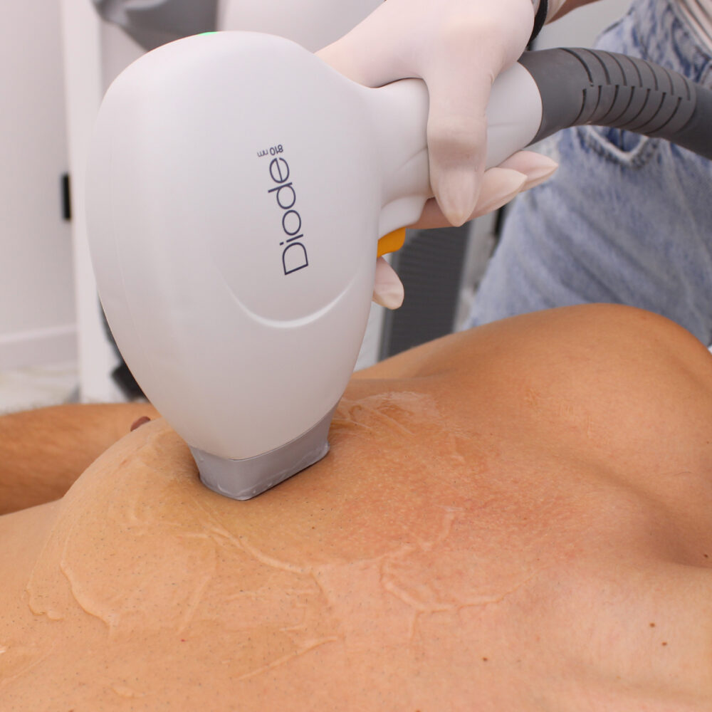 Гърди - Prime Lase HR / лазерна епилация мъже / Русе Prime Lase HR