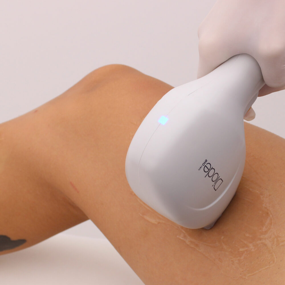 Крака - Prime Lase HR / лазерна епилация мъже / Русе Prime Lase HR