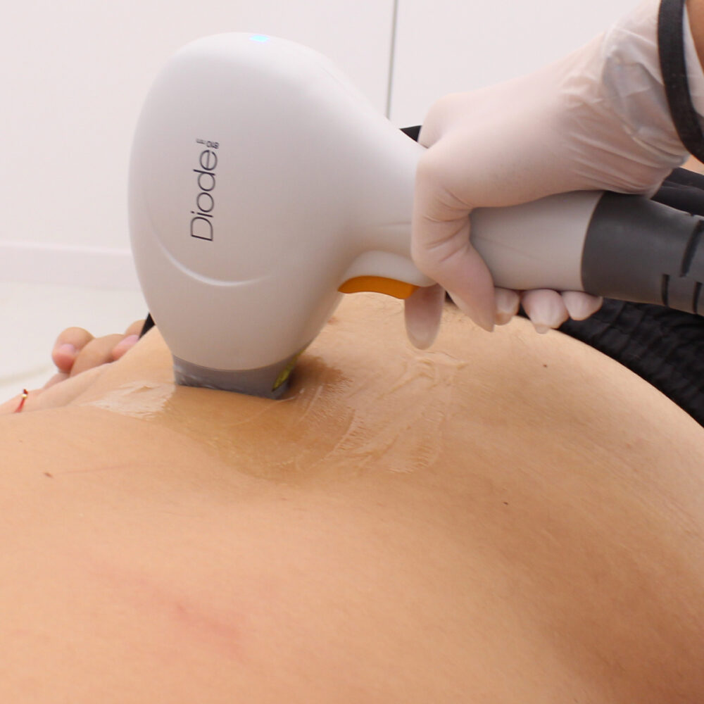 Кръст - Prime Lase HR / лазерна епилация мъже / Русе Prime Lase HR