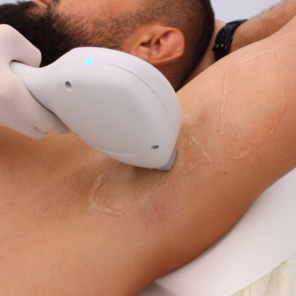 Подмишници - Prime Lase HR / лазерна епилация мъже / Русе Prime Lase HR