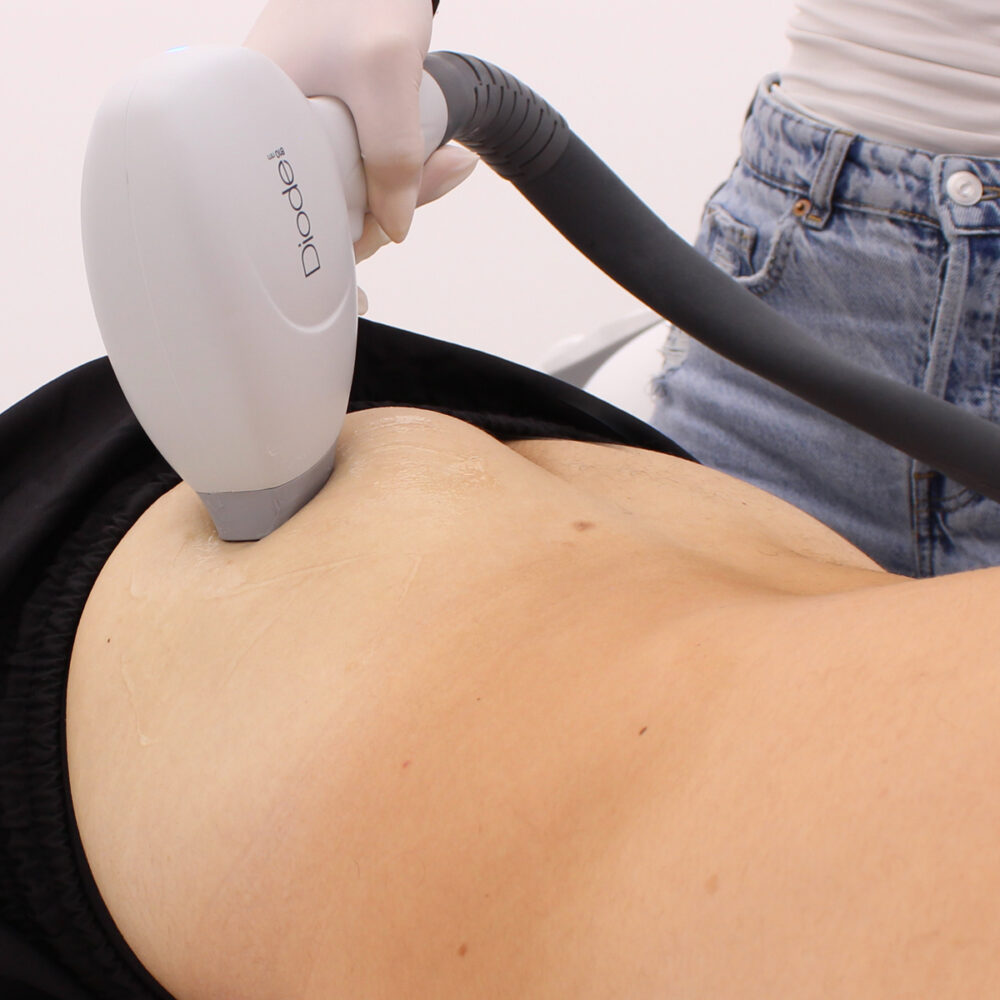 Седелище - Prime Lase HR / лазерна епилация мъже / Русе Prime Lase HR